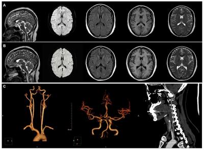 Disappearance of aura symptoms in patients with hemiplegic migraine after patent foramen ovale closure: a case report and literature review